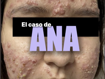 Acne Inflamatorio