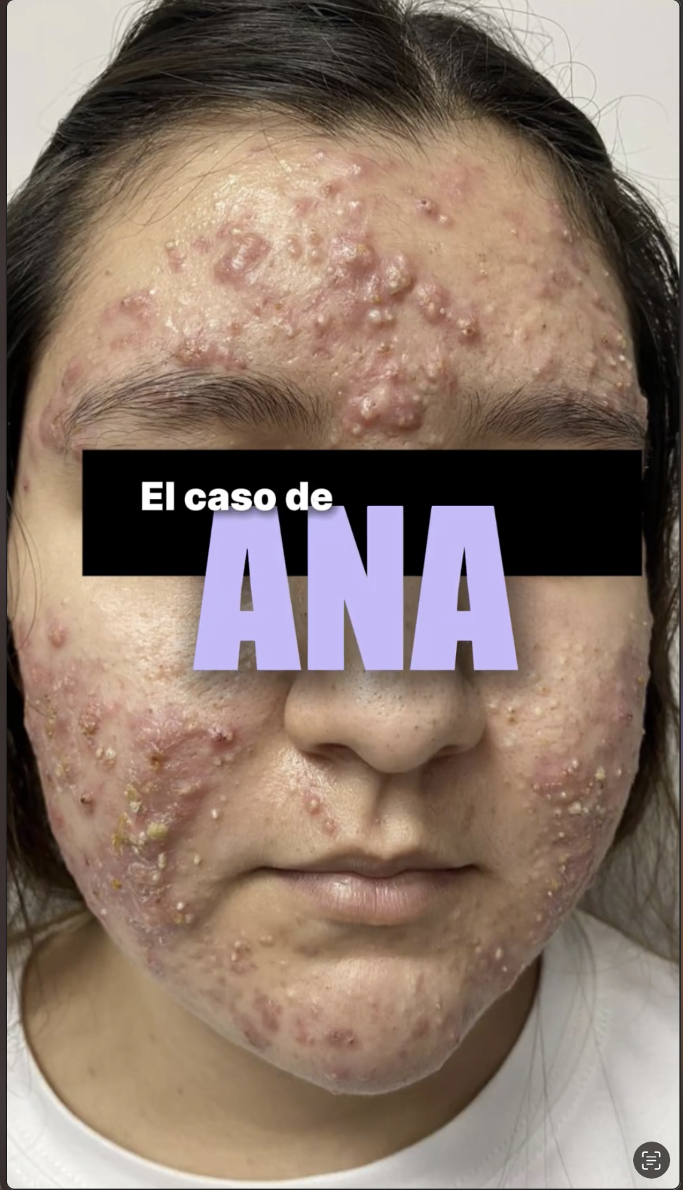 Acne Inflamatorio